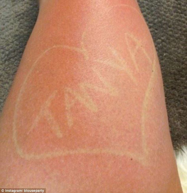 sunburn art 3