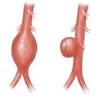 aortane