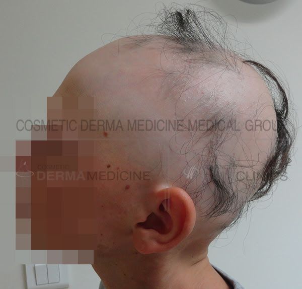 ALOPEKIA 1
