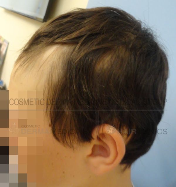 ALOPEKIA 2