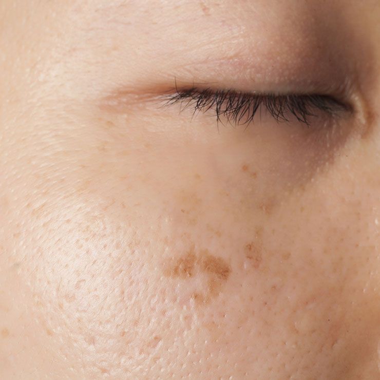 melasma gettyimages 187156838
