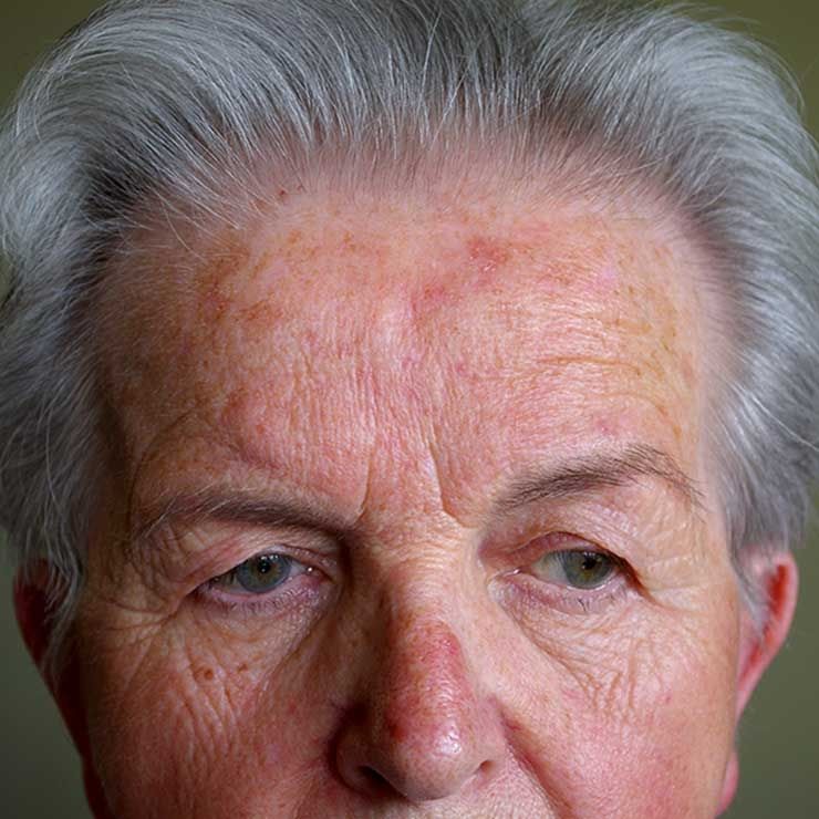 rosacea scimat scimat 0