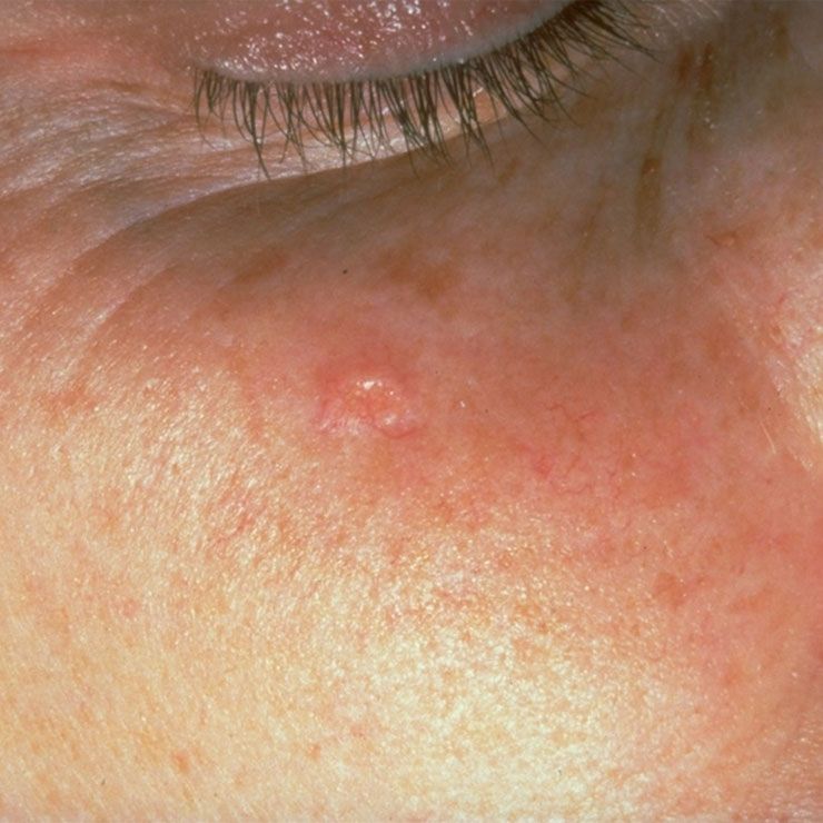 sebaceous hyperplasia 3019 courtesy of american academy