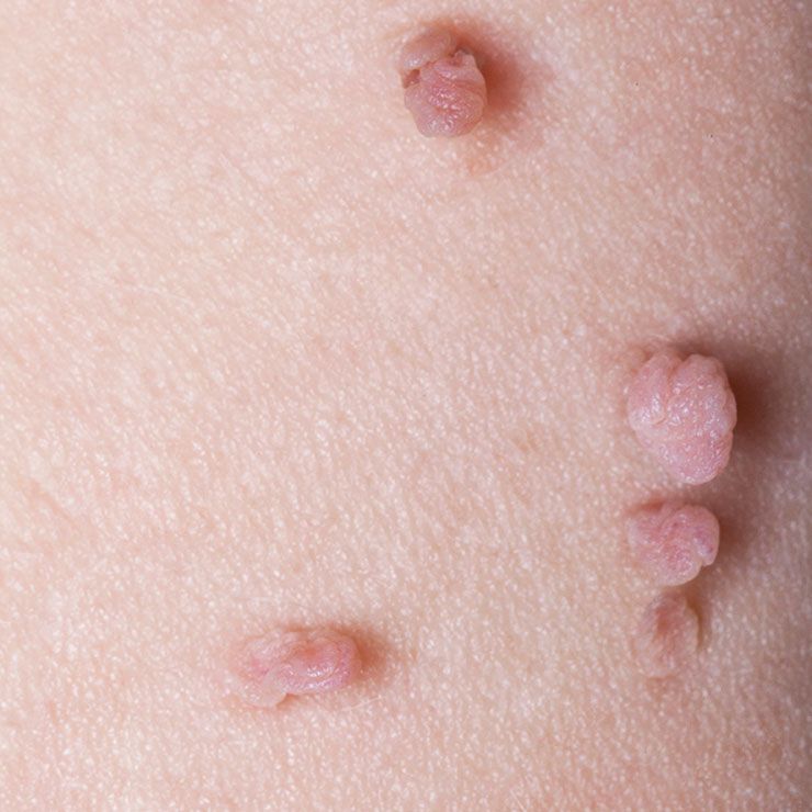 skin tags jodi jacobson gettyimages 157730857