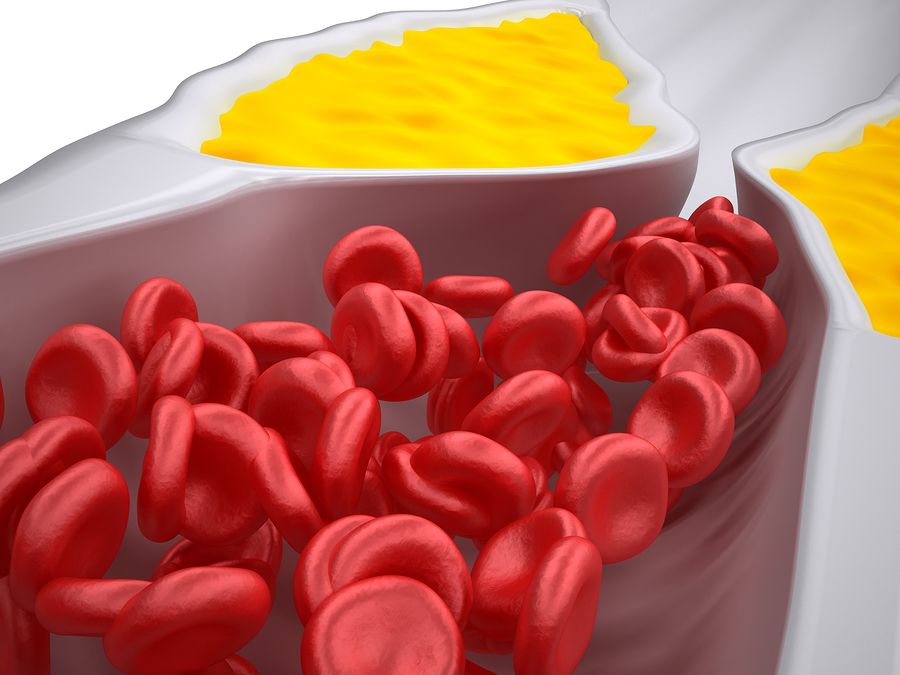 bigstock Clogged Artery Atheroscleros 71560195