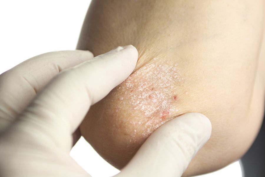 bigstock Psoriasis On Elbows 68407387