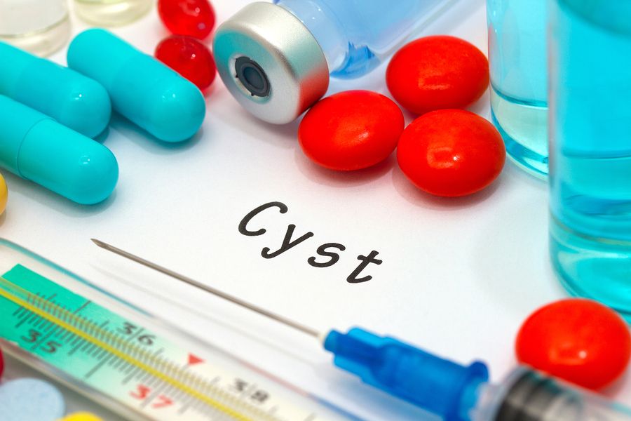 bigstock Cyst 107898464