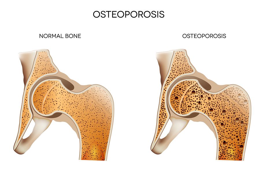 bigstock Osteoporosis 44323384