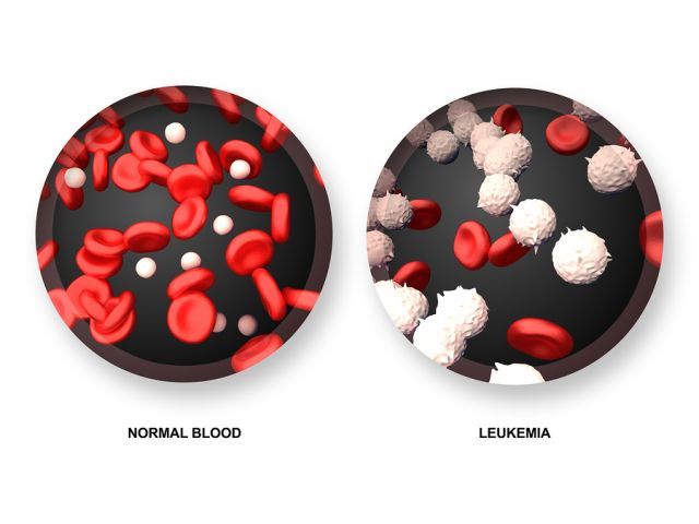 bigstock Leukemia vs Normal Blood 71559931