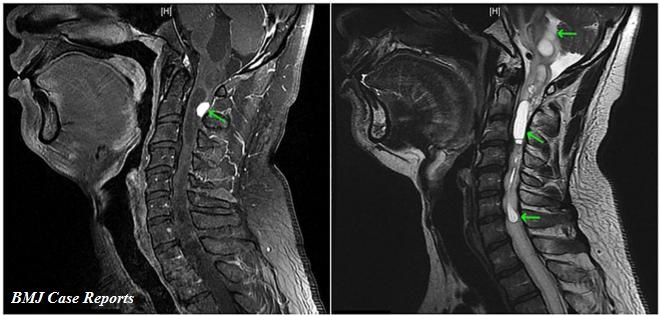 hemangioblastoma BMJ