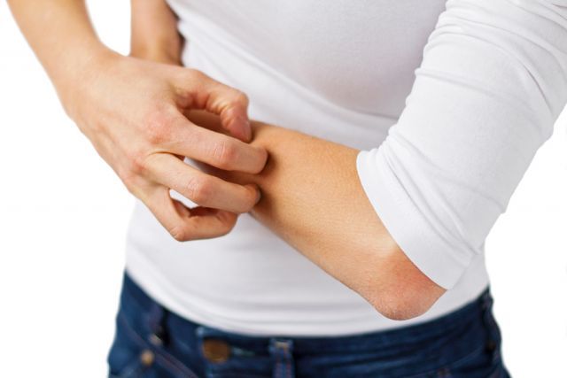 bigstock Eczema dermatitis and itchy s 79387837