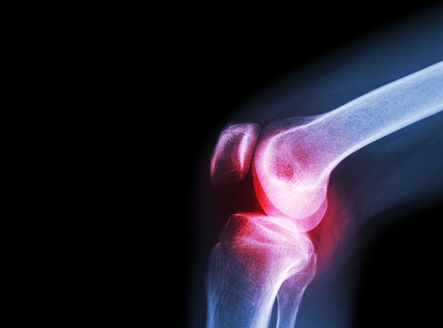 bigstock Film X ray Knee Joint With Art 104401274
