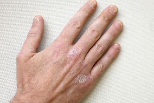 bigstock Psoriasis Psoriasis On The H 6868476