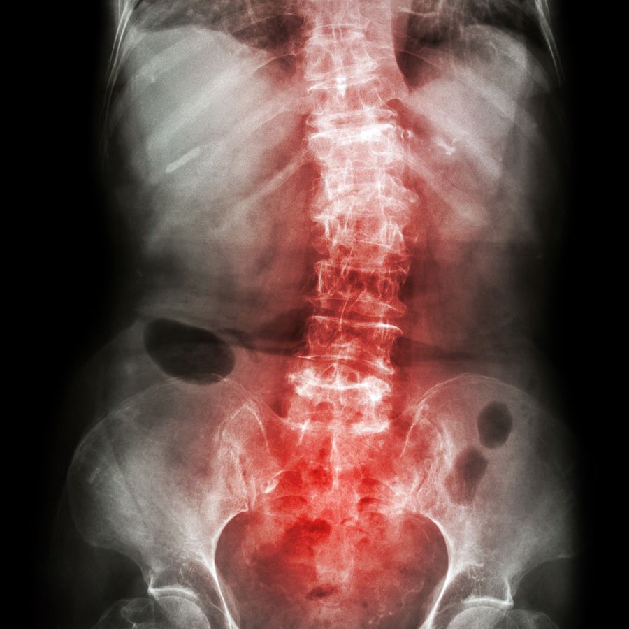 bigstock Spondylosis And Scoliosis 105632198