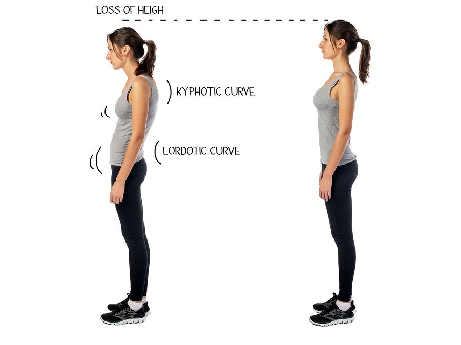 bigstock Woman with impaired posture po 86846264