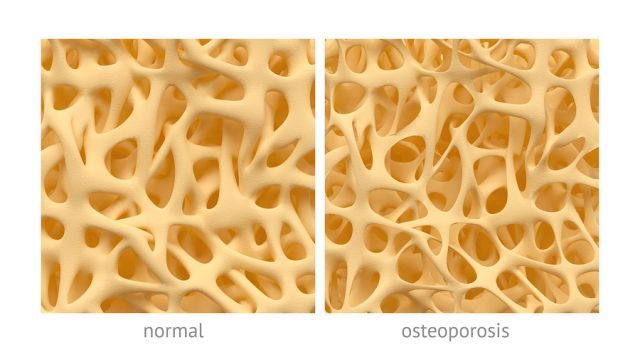 bigstock Osteoporosis 82912145