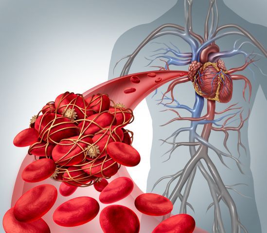 bigstock Blood Clot Risk 107701121