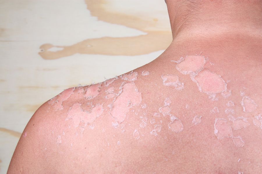 bigstock Sunburned Back 100840310