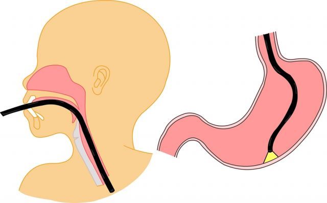 bigstock Endoscopy 6893270