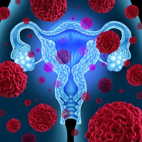 bigstock Uterus Cancer 72374887