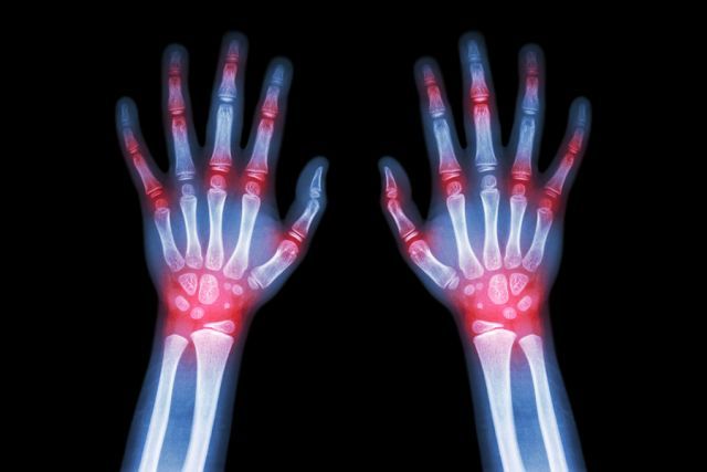 bigstock Rheumatoid Arthritis Gout Ar 103755428