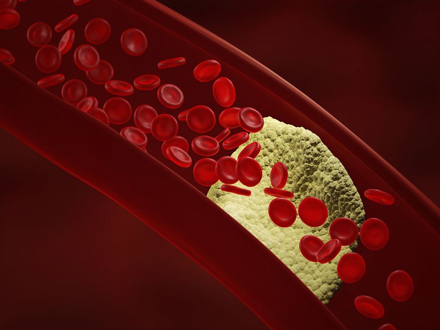 bigstock Atherosclerosis 102572897