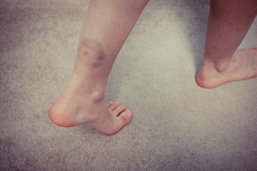 bigstock Woman s Leg With Bruise 64432423