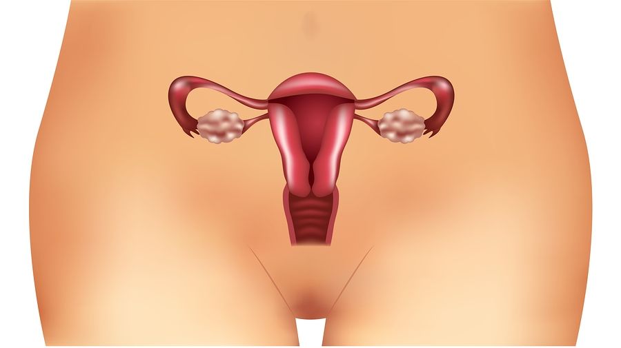 bigstock Polycystic ovary syndrome 208267431