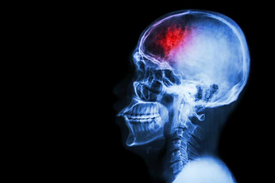 bigstock Stroke cerebrovascular acci 78569471