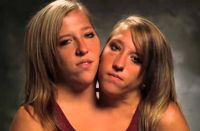 Abby and Brittany conjoined twins 1