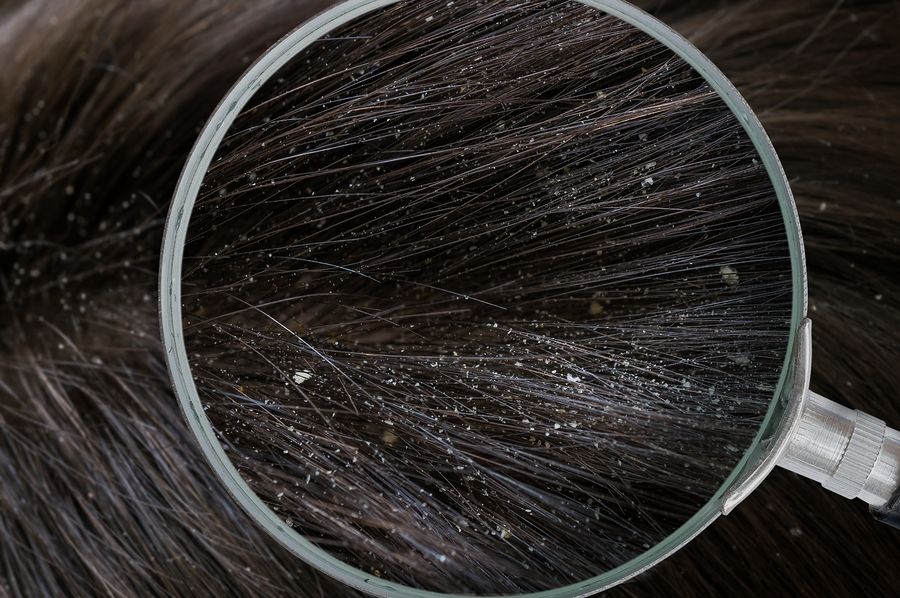 bigstock Examiming White Dandruff Flake 136327064