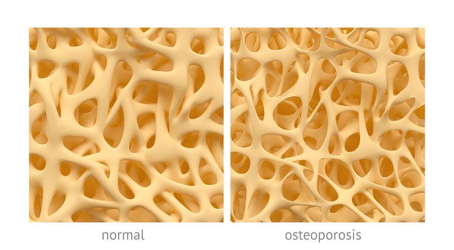 bigstock Osteoporosis 82912145