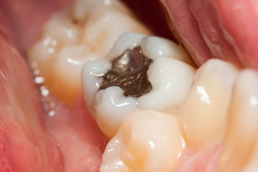bigstock Amalgam Filling 7454266
