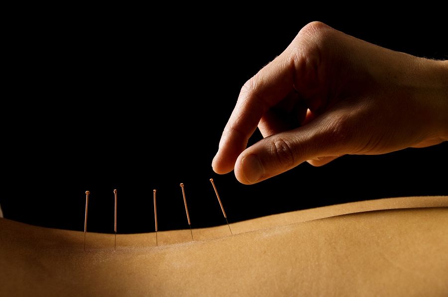 bigstock Acupuncture 3093185