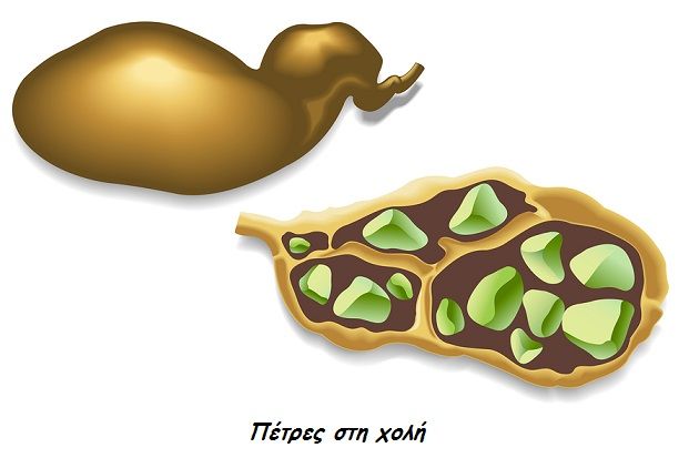 bigstock Gallstones 65554186