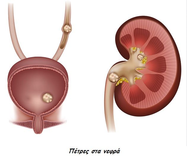 bigstock Stones In The Kidney Urinary 66477544