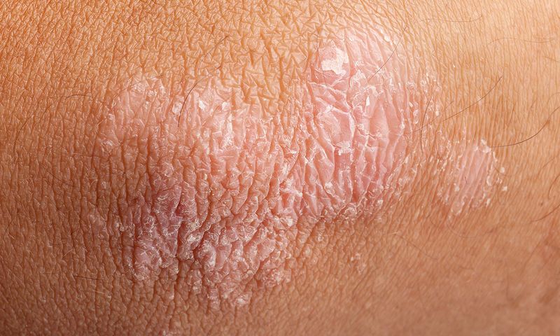 bigstock Psoriasis On Elbow Skin 65113735