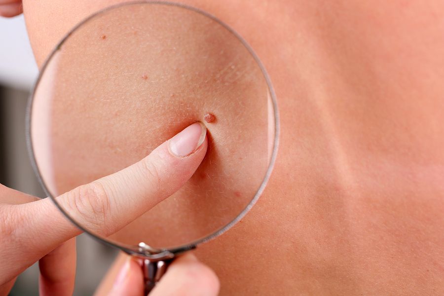 bigstock Dermatologist examines a birth 55697471