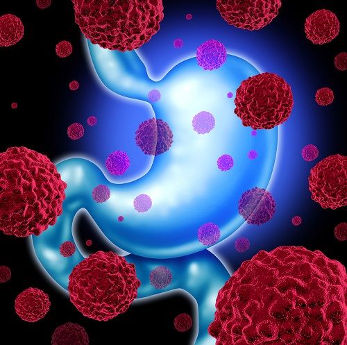 bigstock Stomach Cancer 85358741
