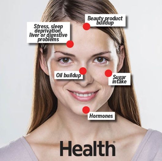the True Cause of Your Breakouts