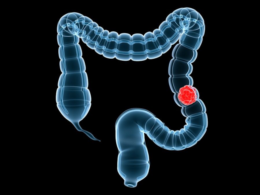 bigstock Colon Cancer 3304506