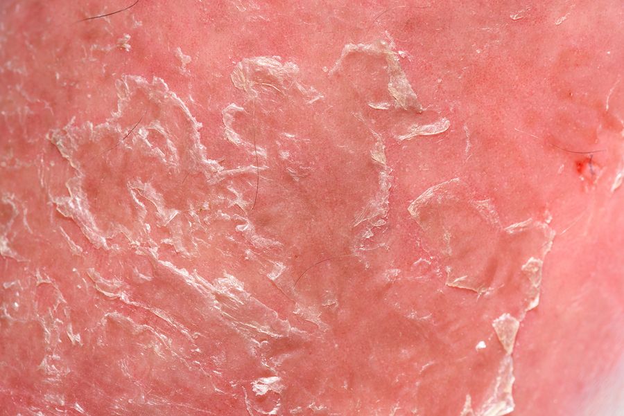 bigstock Psoriasis Skin 138923516