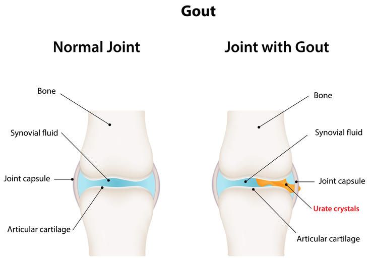 shutterstock 181514690 gout joshya