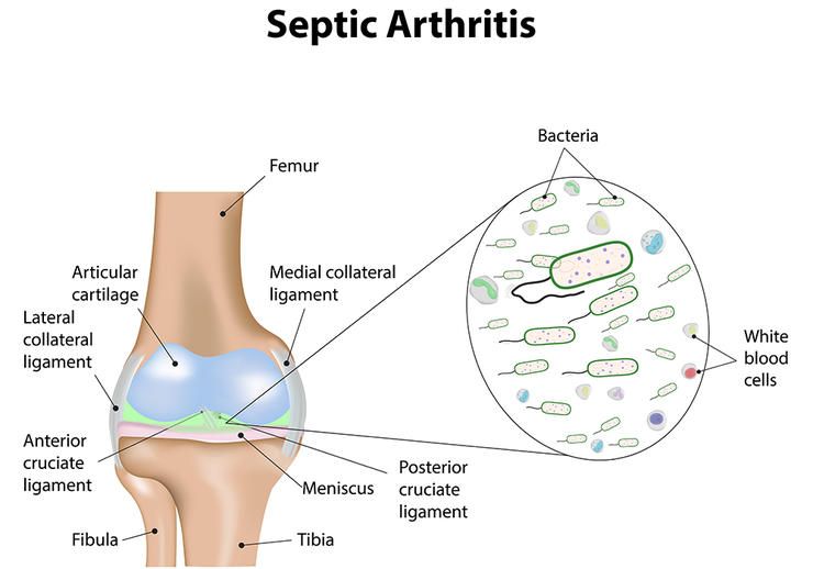 shutterstock 202919668 septic arthritis joshya