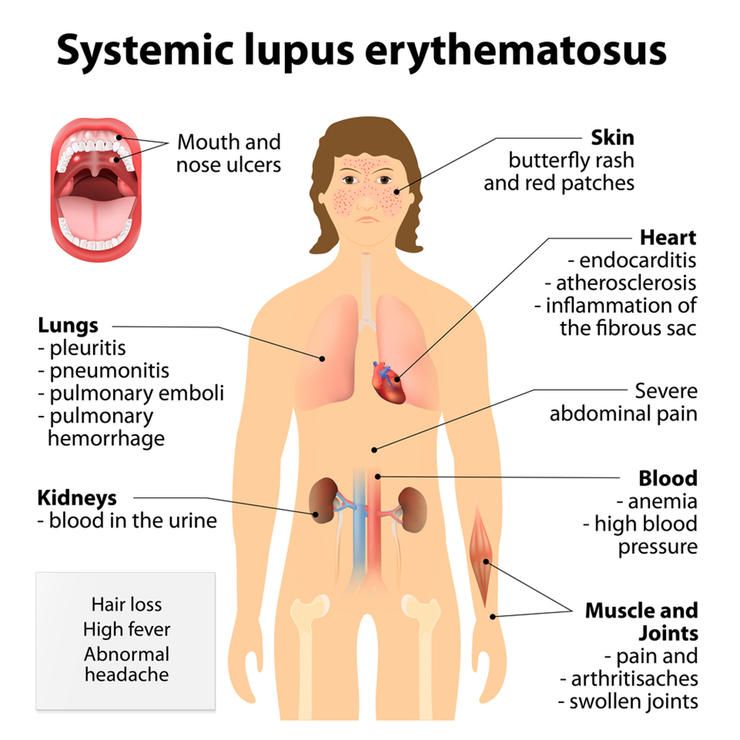 shutterstock 302168915 lupus designua
