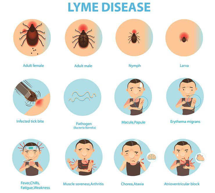 shutterstock 432330661 lyme disease ann131313
