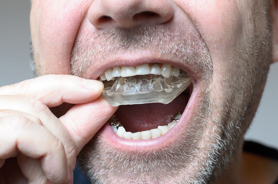 bigstock Man Placing A Bite Plate In Hi 161868617