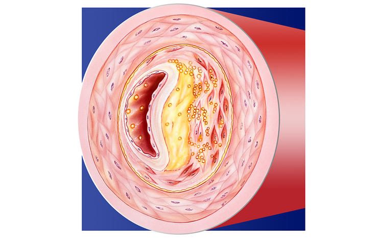 shutterstock 469654007 high cholesterol medical art inc