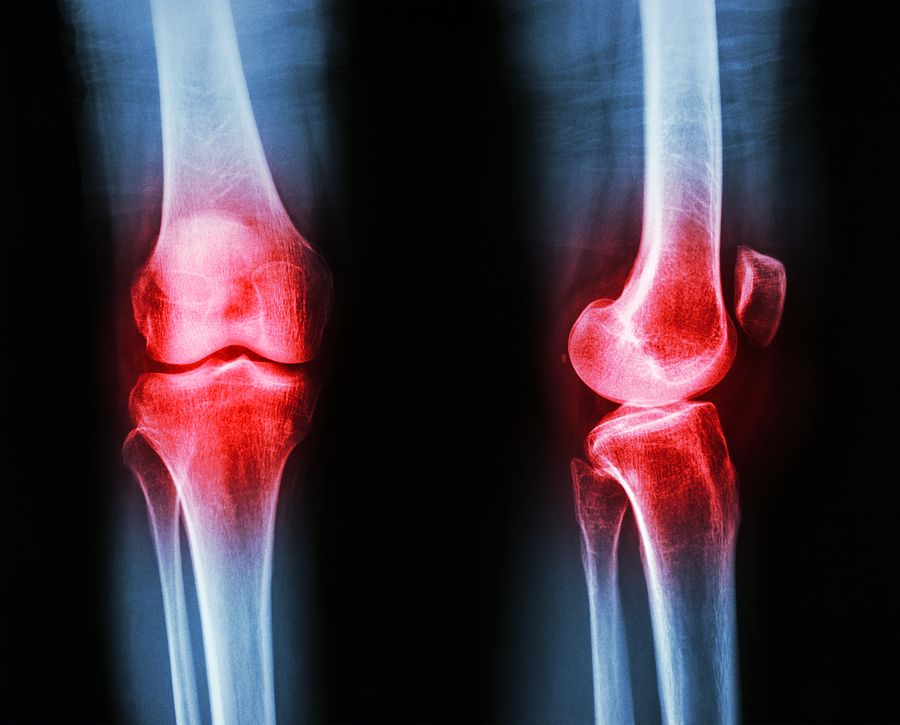bigstock Osteoarthritis knee 78730328