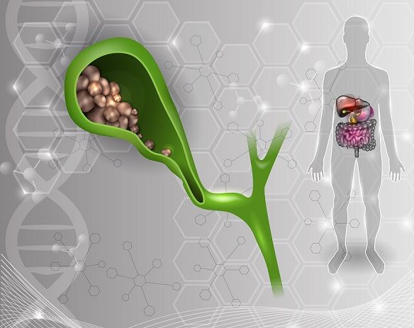 bigstock Gallstones In The Gallbladder 161508563